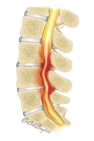 A mellkasi gerinc osteochondrosisával a gerinccsatorna összenyomódása következik be