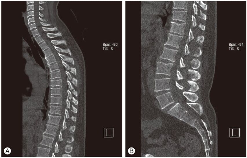 Az intervertebralis lemezek deformációja MRI-felvételeken mellkasi osteochondrosisban