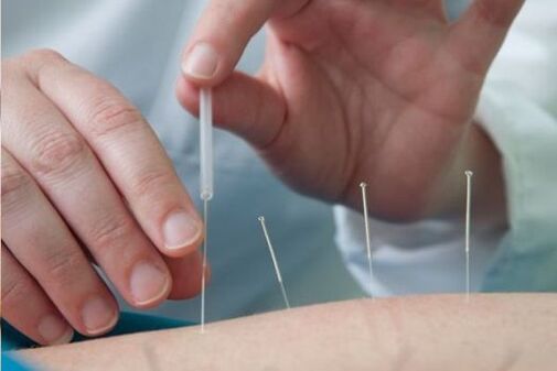 Akupunktúra - az osteochondrosis által okozott fájdalom kezelésére az ágyéki régióban