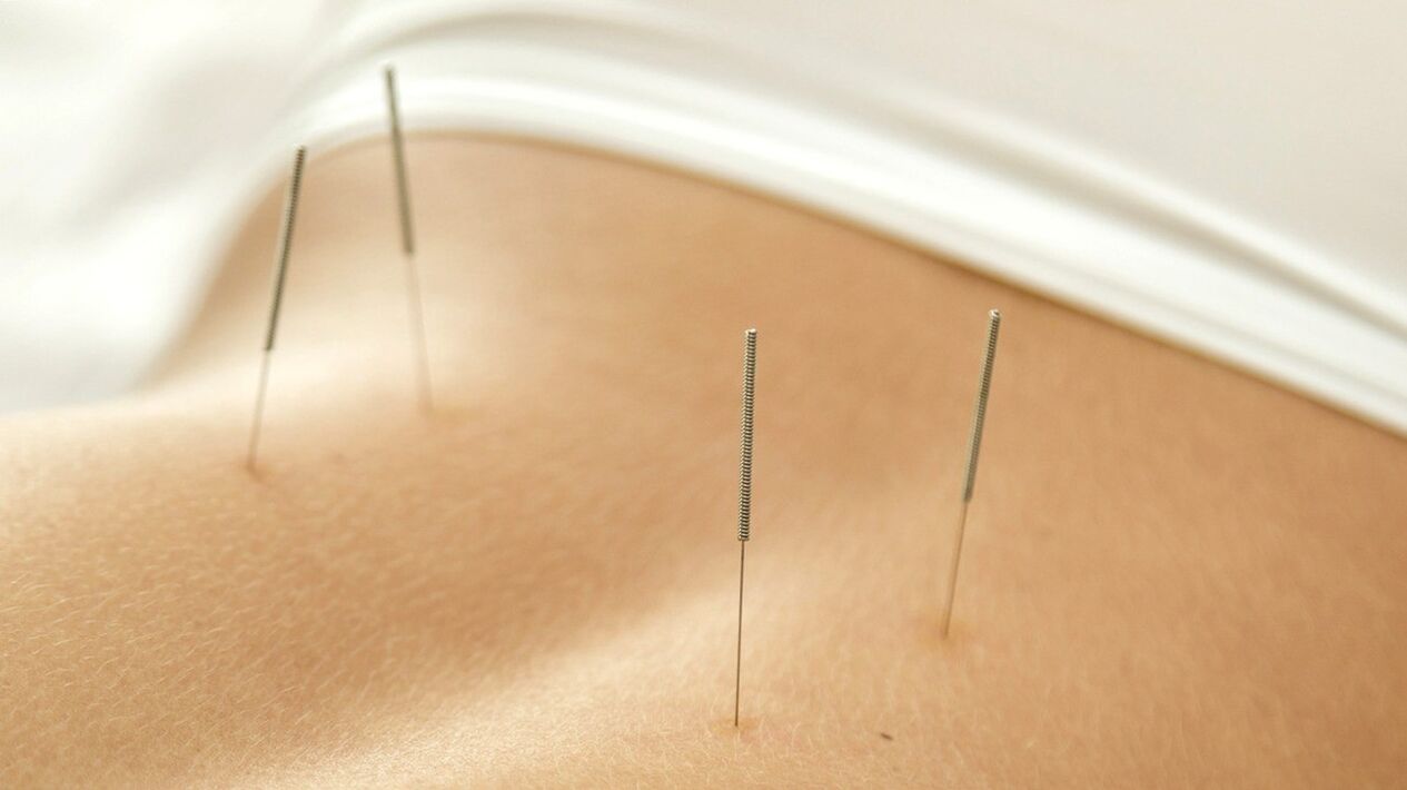 Az akupunktúra segít megszabadulni az alsó hátfájástól