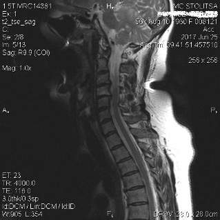 Osteochondrosis spondylosis, valamint a nyaki gerinc